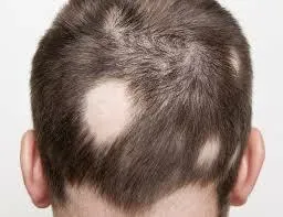 「圓禿」讓青少年失去自信「恐導致拒學」　醫師：確認落髮原因…藥物可治療