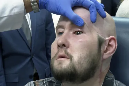 遭電擊毀容！美國男接受全球首例「全眼移植」　可望重見光明