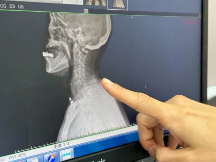 70歲婦頭、脖子痛到受不了　就醫一照驚呆「脊椎呈S型」！
