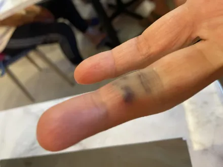 小琉球遊客遭海膽刺傷！「10幾根黑刺」插手指　慘變蜂窩性組織炎
