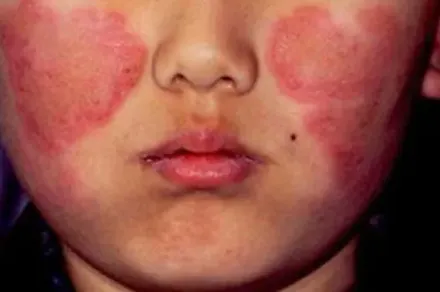 驚！確診後「不死癌症」患者增3倍！連小五女童都中　臉上浮蝴蝶斑
