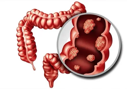 10年暴增3成！每10人就有7人有腸息肉　其中1成8「易癌化」