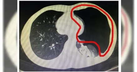 年輕人大便太用力...把肺「憋破」了！左肺「萎縮9成」嚴重影響呼吸功能