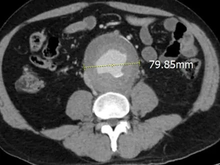 腰痛、背痛以為腎結石復發！醫揪近8cm巨大「腹主動脈瘤」