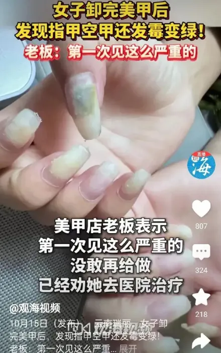 愛美女生注意！雲南女子卸美甲　指甲竟發霉變綠