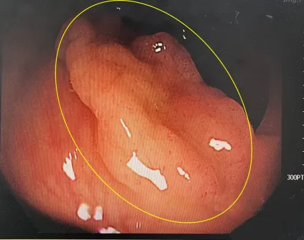 婦僅「便便不成形」竟揪出5cm腫瘤　醫：再晚會變大腸癌