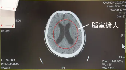 翁「水腦症」全身無力、癡呆合併尿失禁　好發60歲以上長輩