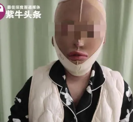 恐怖！湖北男不滿分手潑汽油　致女友全身7成燒傷毀容截肢