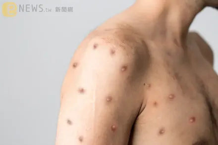 台灣南北已有4例猴痘！英國醫學期刊發現98%都在「特殊交友圈」感染