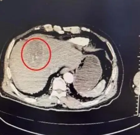 一名近70歲老奶奶跳完廣場舞後腫瘤破裂出血。(圖/翻攝《光明網》)