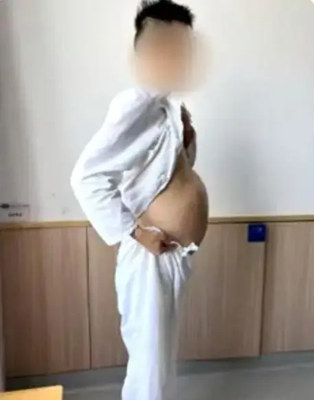 柏男便秘長達4個月腹部隆起如懷孕。 (圖/翻攝江蘇新聞)