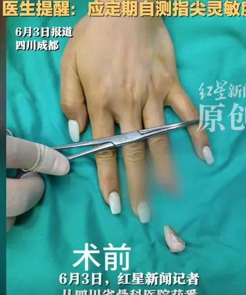 女子無名指末端斷裂。（圖/翻攝新浪微博）