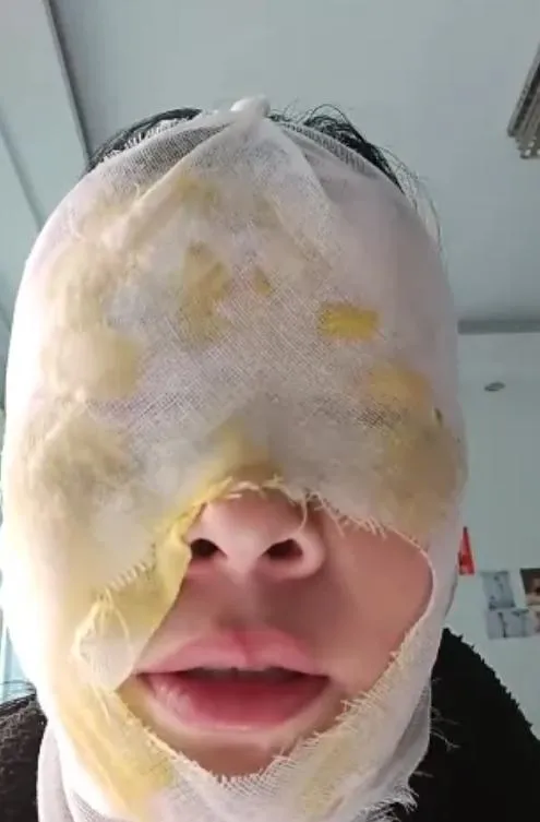吳姓女子去除水垢過程操作不當導致水壺瞬間爆炸,燙傷臉部。(圖/翻攝《央視財經》)