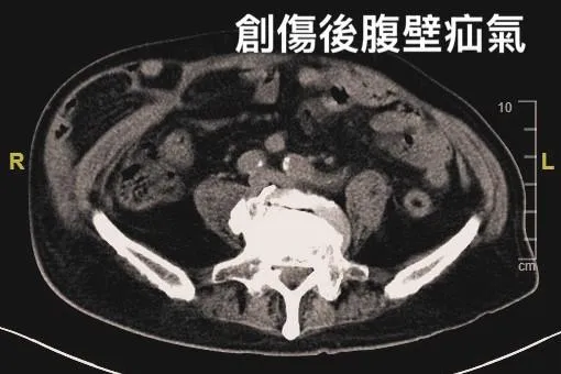 斷層掃描顯示李先生右下腹巨大腹壁疝氣,並合併腸道外露。(圖/亞東醫院)