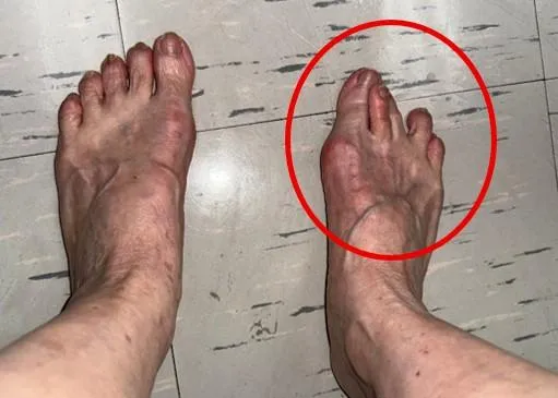 拇趾外翻引發連鎖效應,導致第二趾形成「爪狀趾」。(圖/臺北市立聯合醫院)