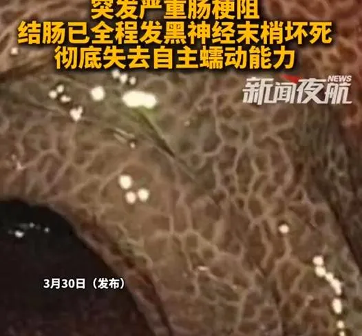 廖女腸道出現「豹紋狀」。(圖/翻攝新浪微博)