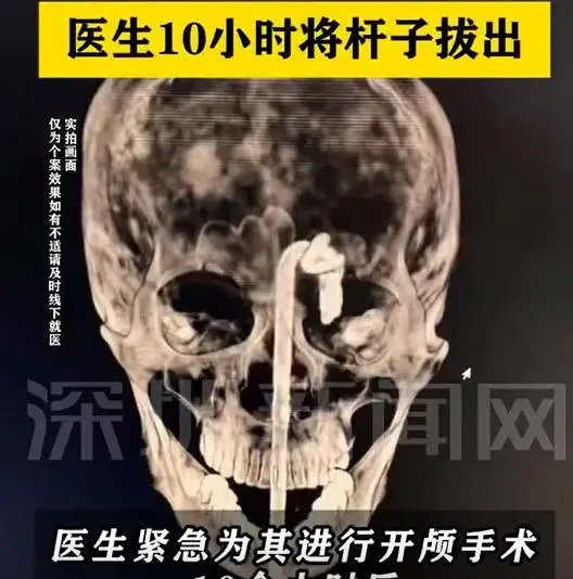 檢查顯示，鐵支從口腔一路貫穿到顱內。（圖/翻攝新浪微博）