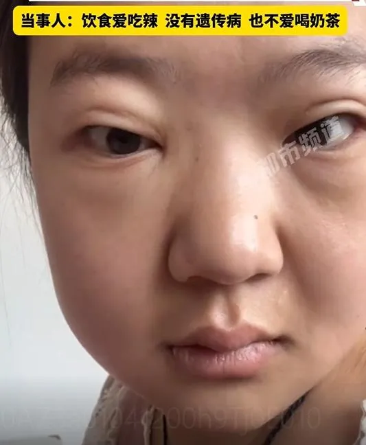 女子臉部明顯腫脹，（圖／翻攝新浪微博）
