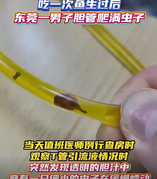 劉男引流出的膽汁竟赫見寄生蟲。（圖／翻攝新浪微博）