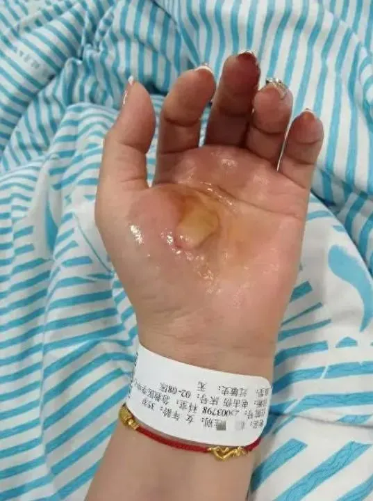 該女子被診斷為電擊傷,左手手掌上有明顯的燙痕。(圖/翻攝自「華商報大風新聞」)