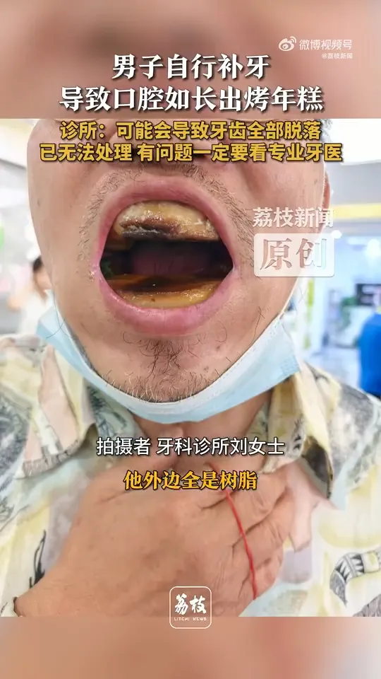 天津一男子買樹脂自行補牙釀成嚴重後果。（圖／翻攝微博@荔枝新聞）