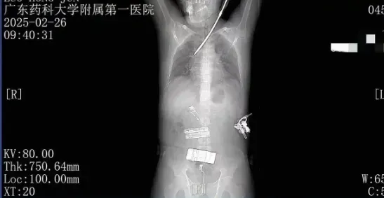 醫院檢查後診斷螺絲刀異物刺入患者肺部。（圖／翻攝《羊城派》）