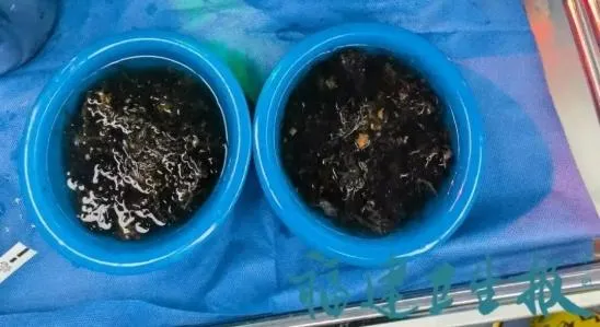 醫療團隊從小可胃中清理出兩大盆頭髮。（圖／翻攝《杭州日報》）