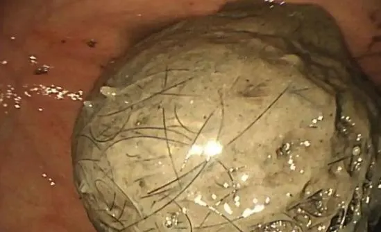 醫療團隊在小可胃中發現大量頭髮形成的胃石。（圖／翻攝《杭州日報》）