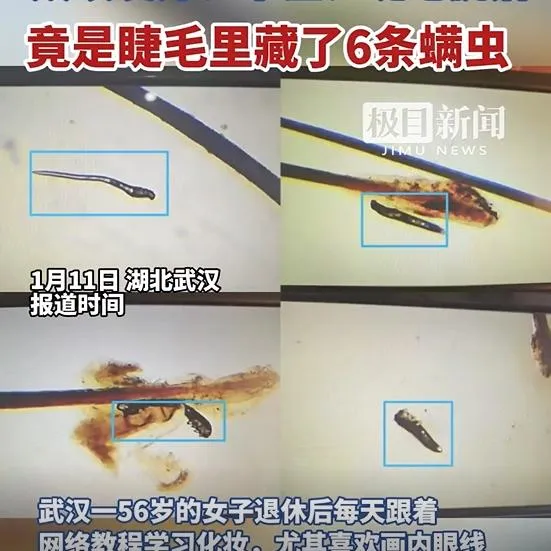 陸女睫毛內發現6條蠕形蟎。（圖／翻攝新浪微博）