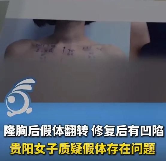 貴州女子隆胸與院方發生爭議。（圖／翻攝新浪微博）