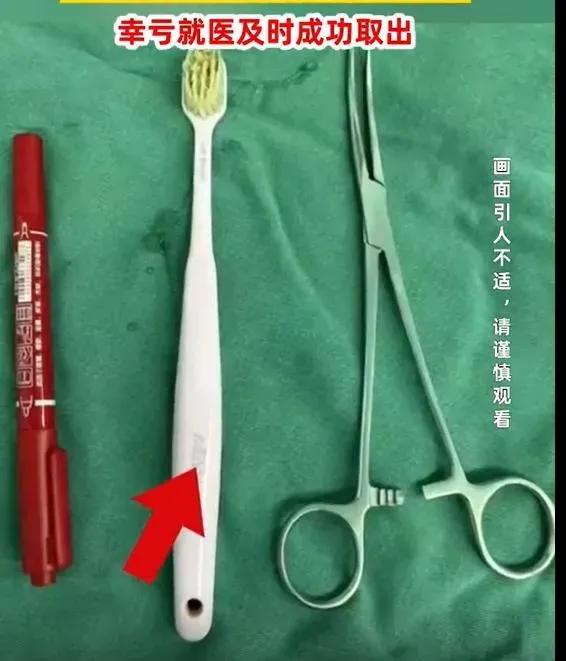 醫師取出的牙刷。（圖/翻攝新浪微博）