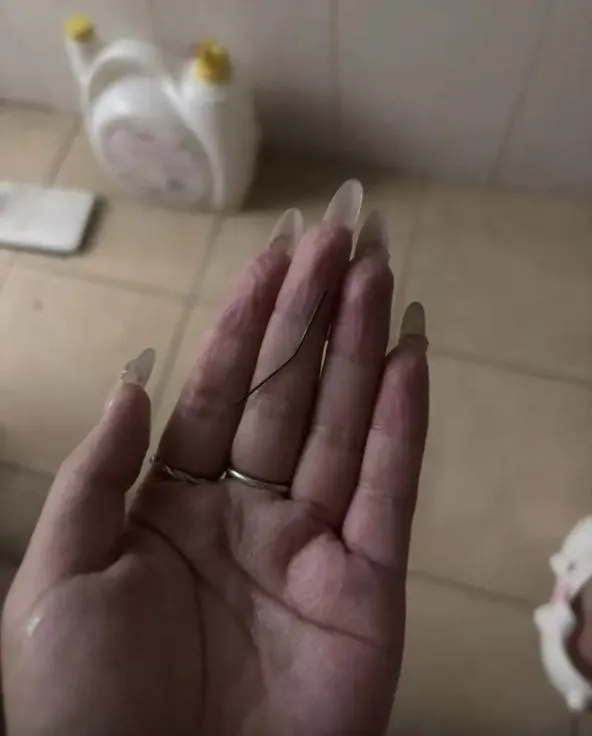 一名浙江女子從臀部拔出一跟生鏽針頭。（圖／翻攝自星島網）