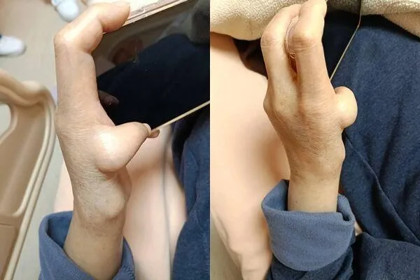 一名60歲婦人因肺炎入院，胸腔科醫師蘇一峰查房時發現其手指構造異常，最終診斷出婦人是罹患范可尼貧血。(翻攝自蘇一峰臉書)
