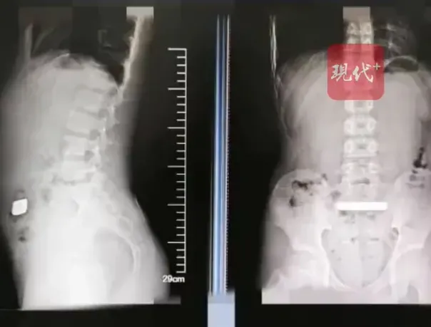 大陸蘇州最近發生1名11歲男童在家玩耍時誤吞金條，醫生替其拍X光片發現金條卡在盆腔不動。（圖／翻攝自微博@現代快報）