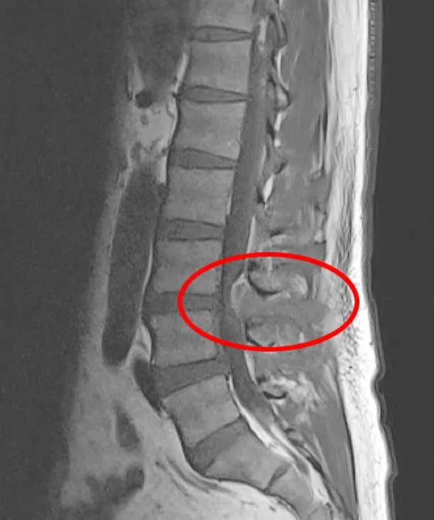 林先生影像檢查發現腰椎硬脊膜外膿瘍合併脊椎骨髓炎。（圖／臺中榮總）
