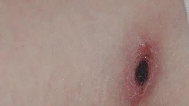 蔡宛庭醫師提醒，民眾若有高燒合併肝功能異常，且有戶外活動史，應將恙蟲病列入鑑別診斷，以免延誤治療時機。（圖／台北市衛生局提供）