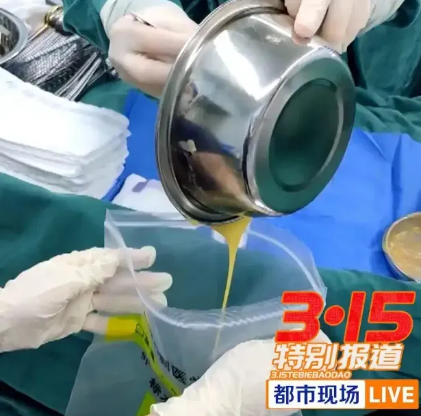 醫師取出玲玲胸部的注射物。（圖／翻攝《都市現場》）