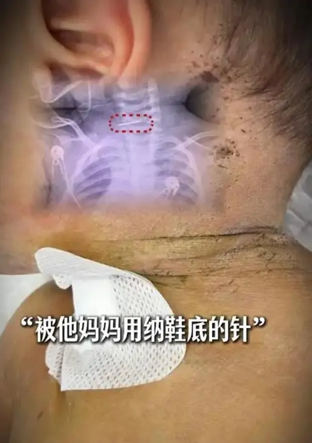 雲南10個月大男嬰遭母狂扎針放血。 (圖/翻攝紅星新聞)