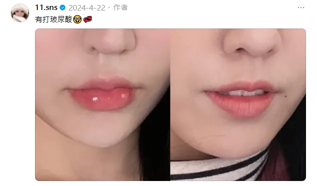 蕭伊透露曾注射玻尿酸填補嘴唇。（圖／翻攝自蕭伊Threads）