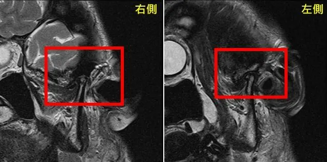病友曾小姐雙罹患側顳顎關節障礙症候群,出現肌筋膜疼痛症、關節盤不可復移位及骨關節炎。(圖/中山附醫)