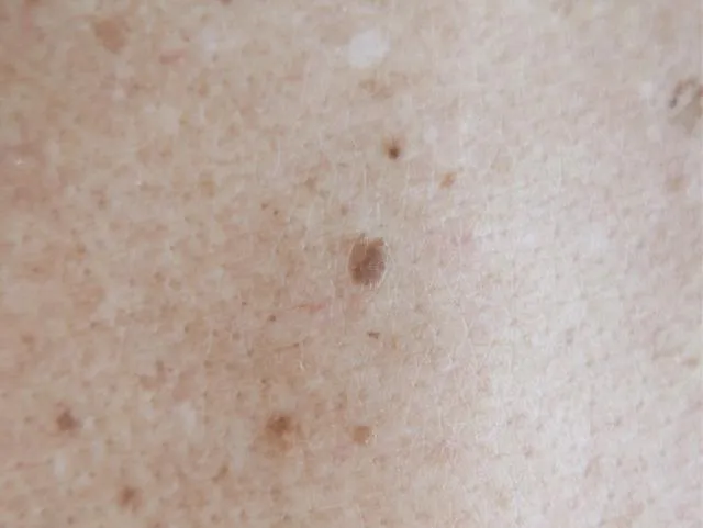 一名60歲男性出現大量老人斑,經皮膚科醫師診斷後發現竟是早期胃癌的警訊。(圖/Photo AC)