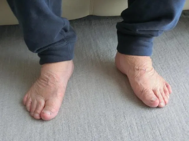 若出現單側腫脹、泡泡尿或全身性浮腫等症狀,應及早就醫檢查心臟、肝臟及腎臟等器官功能。(圖/Photo AC)