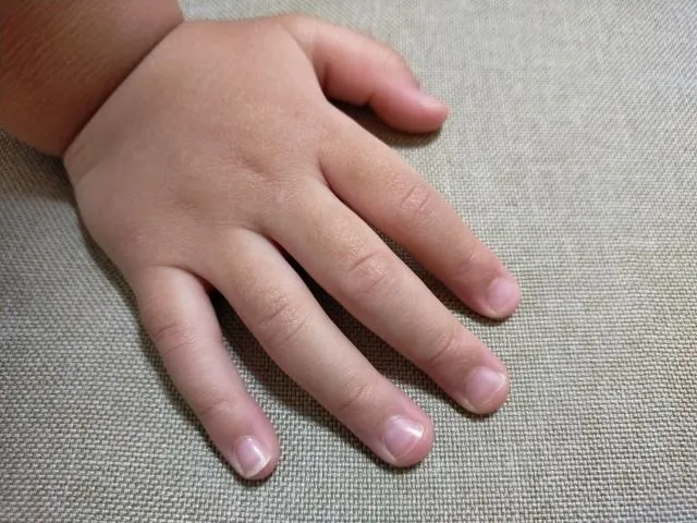 一名媽媽帶著7歲孩子至診間治療異位性皮膚炎，看診結束時反映，孩子近來一直咬指甲。（圖／Photo AC）