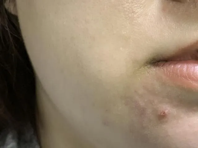 一名大陸女子擠痘痘險發生嚴重感染。(示意圖/photoAC)