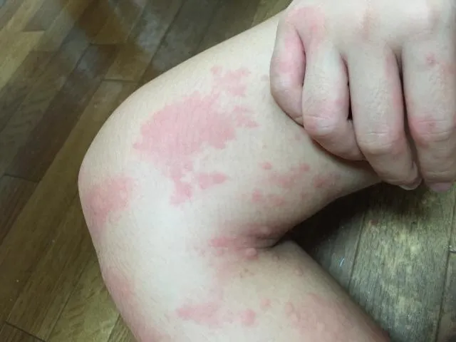 處理兒童蕁麻疹的重點不在於持續壓制癢感，而是協助身體逐步穩定過度反應的狀態。（圖／Photo AC）