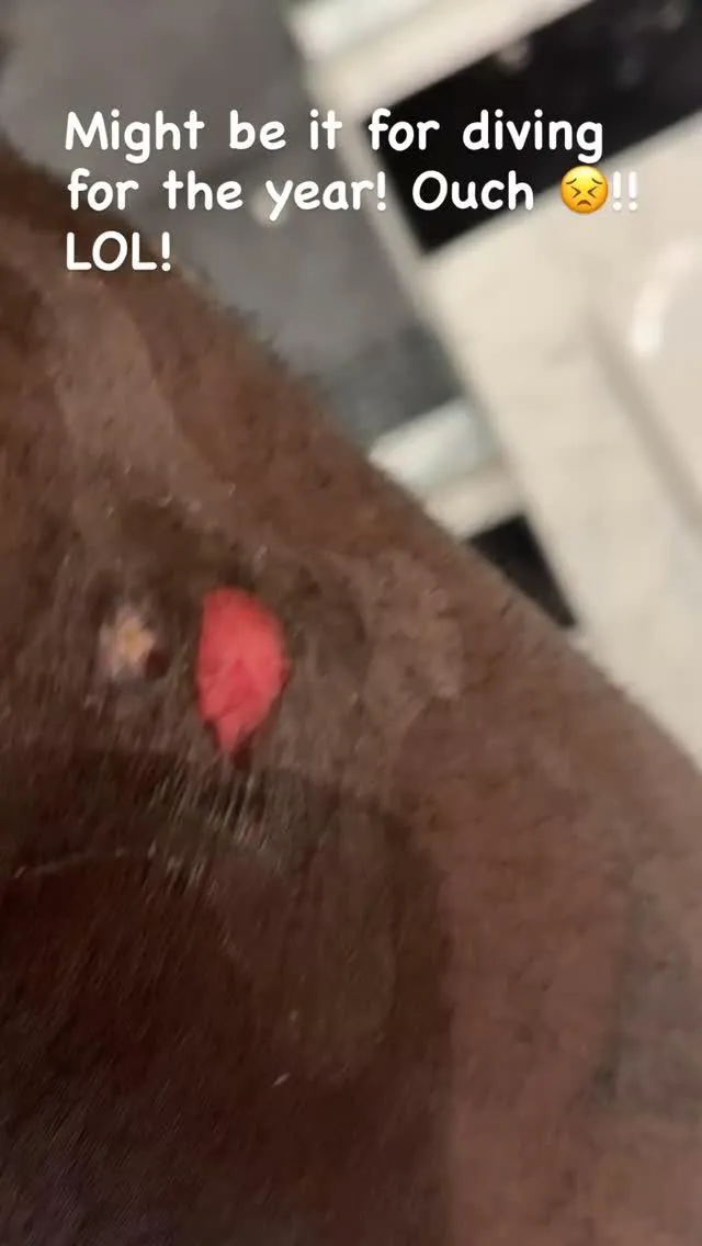 詹姆斯秀出腿部傷口。（圖／翻攝自IG）