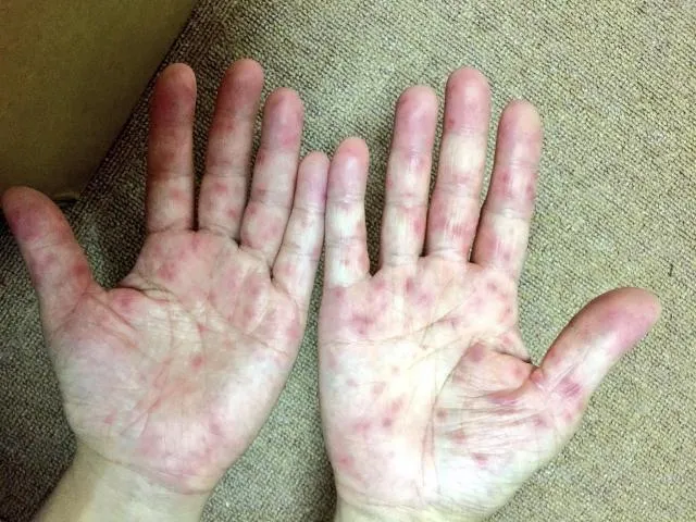 疫情監測數據顯示，今年累計4例腸病毒感染併發重症確定病例，包含1例死亡個案。（圖／Photo AC）