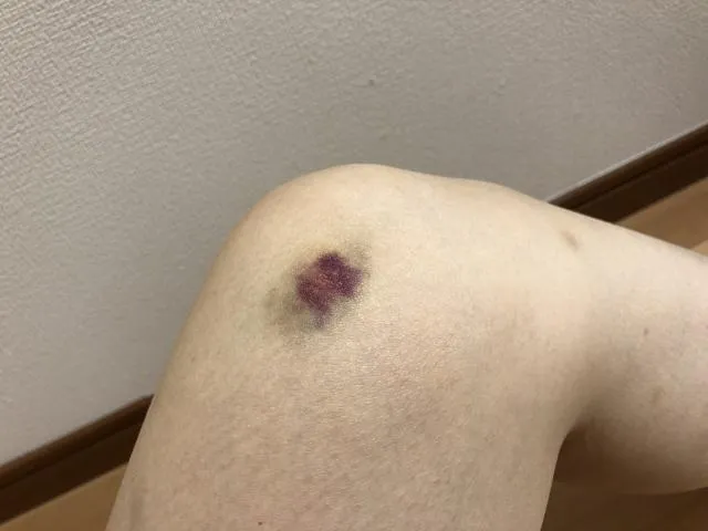 若民眾發現自己容易瘀青或傷口難以止血，應多加留意免疫功能是否出現異常。（圖／Photo AC）