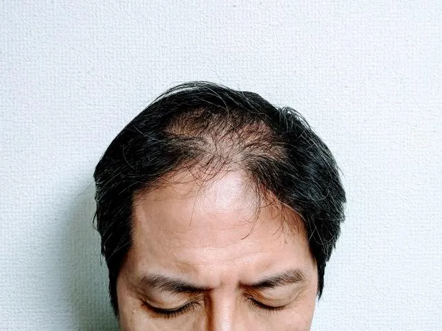 頭髮變細、容易斷裂，不一定是年齡增長的必然結果。（圖／Photo AC）