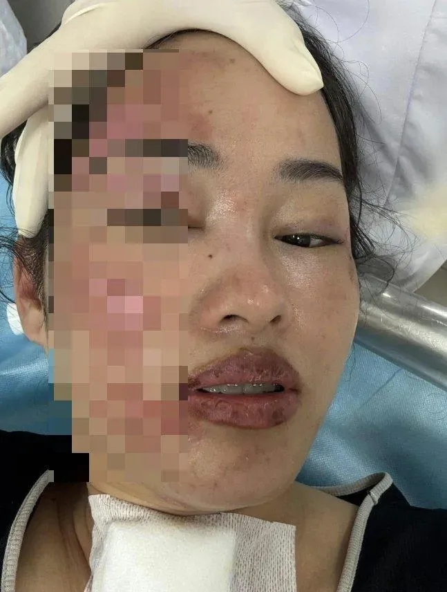 菲姆半張臉燒傷。（圖／翻攝FB）